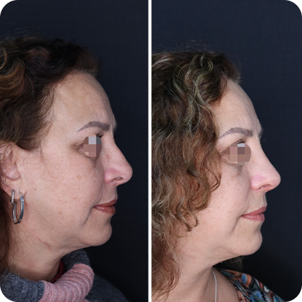 Antes e Depois Rinoplastia 3